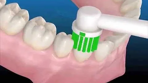 ¿Puede desaparecer la periodontitis con el cepillado?