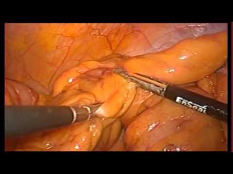 Laparoscopic Surgery In Colorectal Cancer.