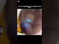 SOME SCALP INFECTION LITERALLY GLOW UNDER UV LIGHT