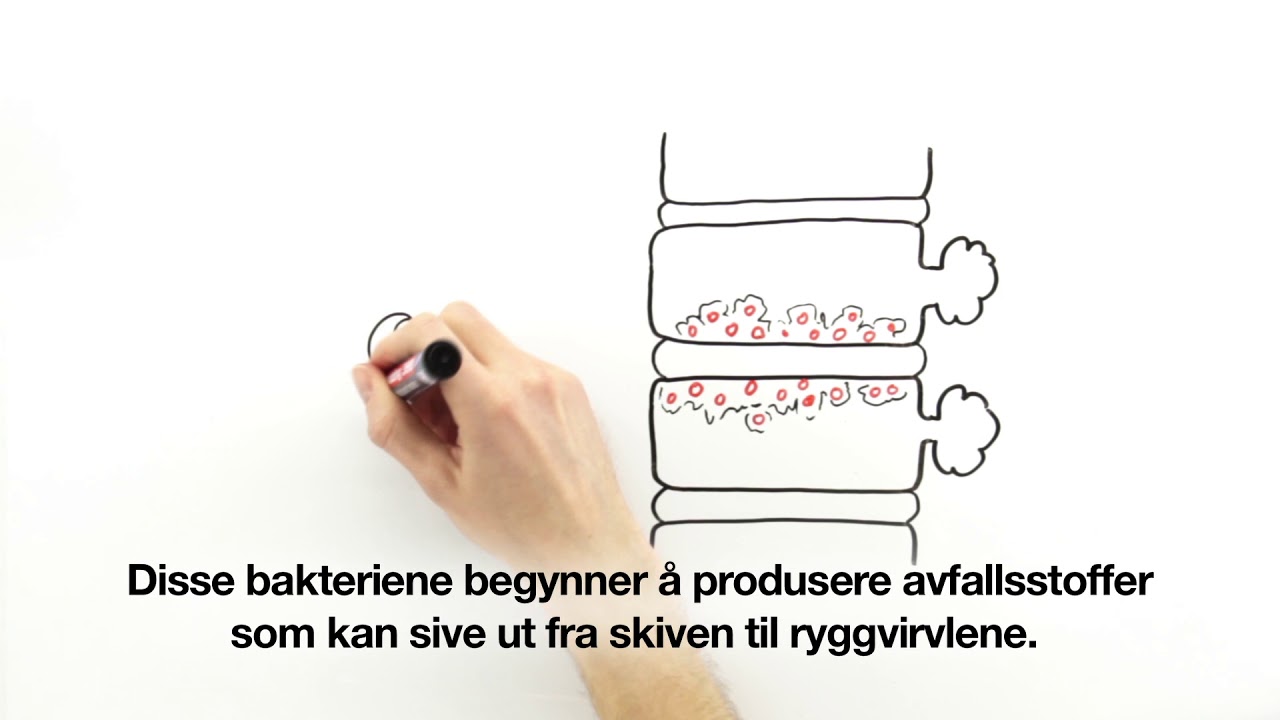 Modic forandringer - forklart av FORMI (tekstet) - YouTube