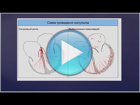 Video: Jinsi ya Kutibu Fibrillation ya Atria: Je! Dawa za Asili Zinaweza Kusaidia?