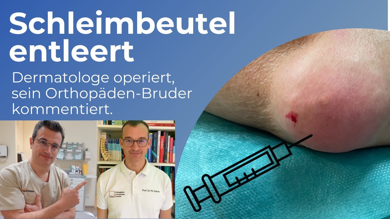 Schleimbeutelentzündung am Ellenbogen punktieren #schleimbeutelentzündung - YouTube