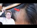 Выпадение волос после вируса 2 Часть | Как восстановить организм после перенесенных заболеваний