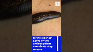 Leech Therapy in ayurveda! #Dangers# precautions#shorts