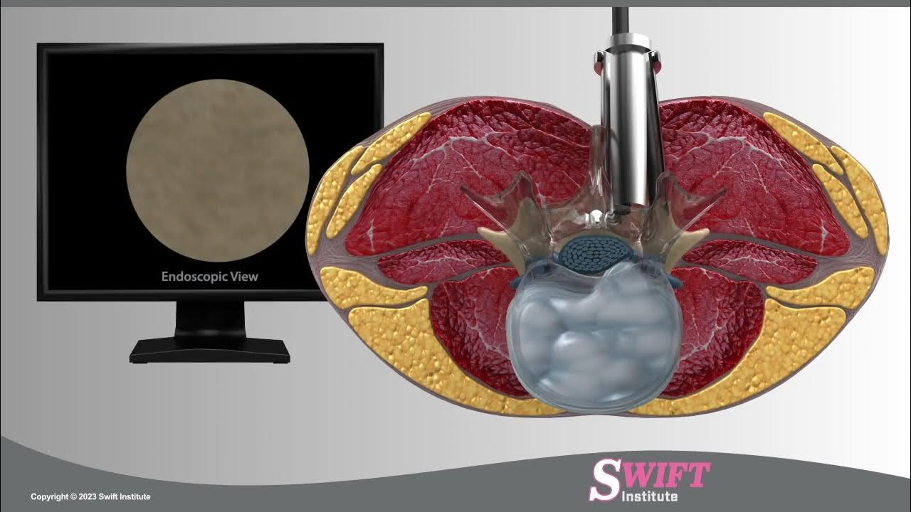 Reno Minimally Invasive Endoscopic Microdiscectomy Swift Institute