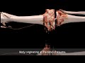 Anatomage Table Patient Case 184 - Knee Replacements and Amputation