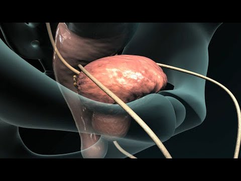 Full TURP procedure (Cutouts)