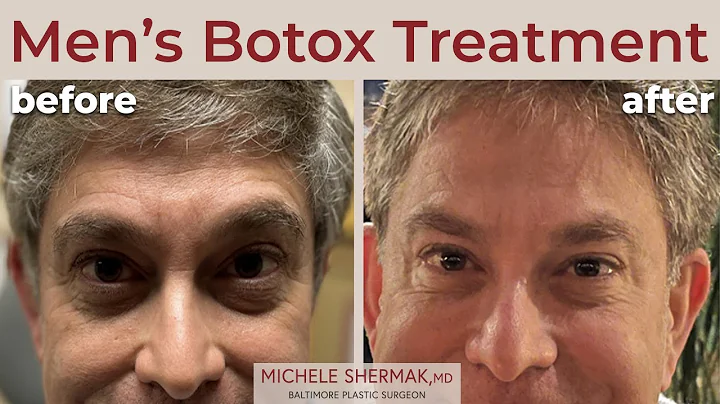 Do Men Get Botox? | Botox Injection Results