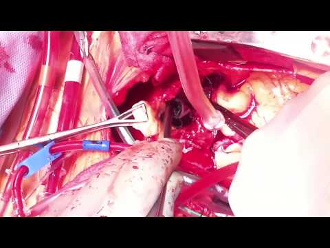 Acute Type A Aortic Dissection Repair