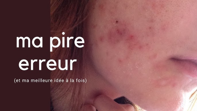 Curacné/Roaccutane : mon traitement et ses effets secondaires ...