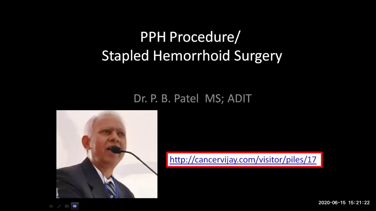 Hemorrhoids / piles PPH Procedure or Stapled Hemorrhoid Surgery