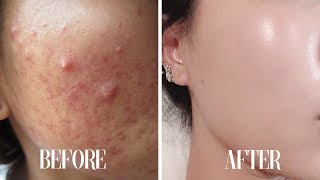 Get CLEAR SKIN subliminal | Get rid of acne in 10 minutes! Resimi