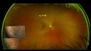 Navilas® - Navigated Laser Retinopexy