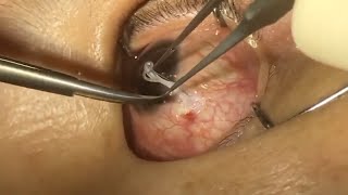 Surgical Removal of Subconjunctival Thelazia