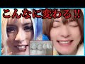 【出っ歯卒業】歯科矯正どれだけ変わる?終了した整形級変化全て見せます。【抜歯】