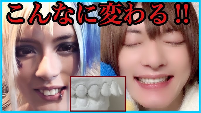 出っ歯卒業 歯科矯正どれだけ変わる 終了した整形級変化全て見せます 抜歯 Youtube 出っ歯卒業 歯科矯正どれだけ変わる 終了した整形級変化全て見せます 抜歯 Youtube