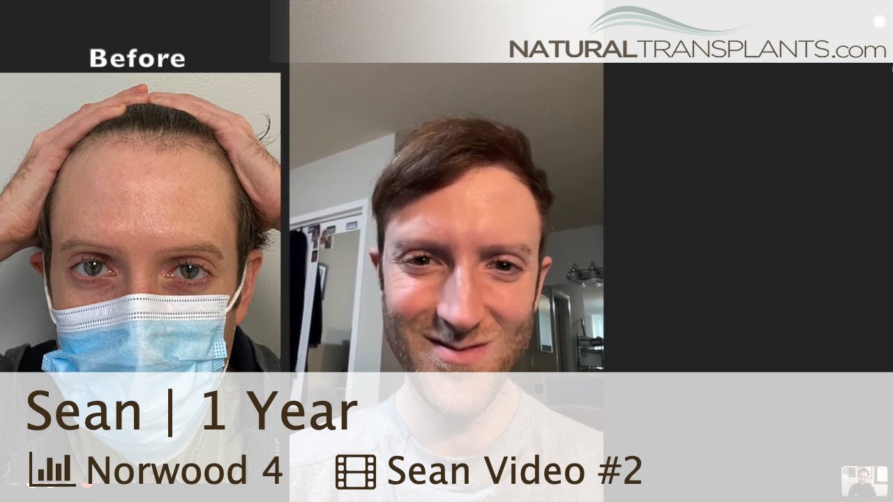 Remarkable 1Year Hair Restoration Results Norwood 4 Dr. Kevin