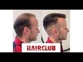 Non surgical hair replacement solution  hair club