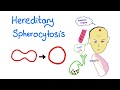 Hereditary Spherocytosis (HS)