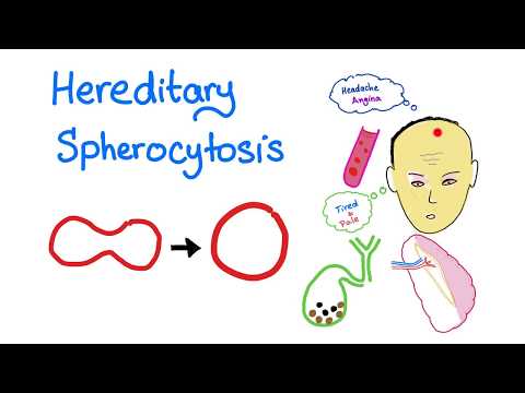 ਖ਼ਾਨਦਾਨੀ Spherocytosis (HS)