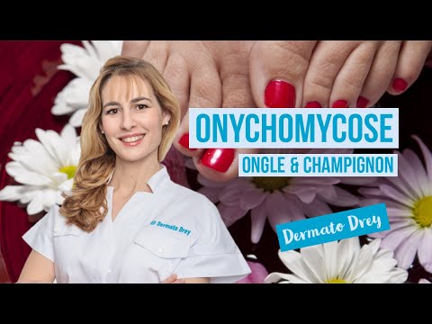 Vidéo: Quand l'onycholyse va-t-elle disparaître ?