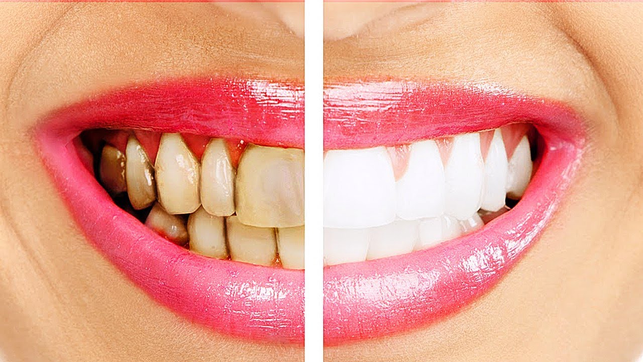 Чистка зубов или отбеливание лучше зубные щетки от 6 месяцев