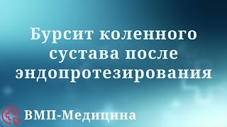 Бурсит коленного сустава после эндопротезирования | ВМП-Медицина