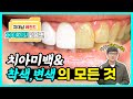 [#치전드] 누런 치아를 하얗게 만들고 싶다고?! 치아의 미백, 착색, 변색에 대해  전부 알려드립니다!!! | 치아 미백 이야기 모음.zip