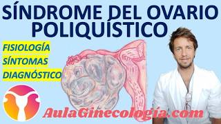 SÍNDROME de OVARIO POLIQUÍSTICO: causas, síntomas y diagnóstico. - Ginecología y Obstetricia -
