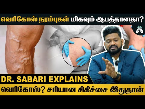 #vericoseveins is an important reason for leg veins | #vericose treatment methods | Dr Sabarinath