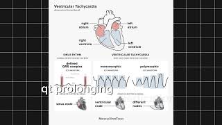 Understanding Ventricular Tachycardia