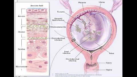 Como diagnosticar ruptura prematura de membranas?