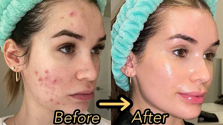 How I Finally Cleared My Acne and Textured Skin! *Hormonal Acne Skincare Routine*