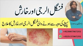 Types Of Fungal Infection & Treatment For Fungal Infection | ClearSkin, Pune | (In URDU)