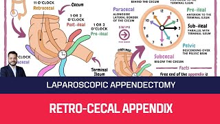 #124 : LAPAROSCOPIC APPENDICECTOMY IN A CASE OF RETROCECAL APENDIX