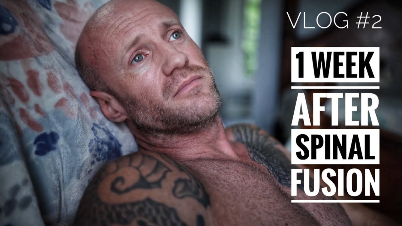 Спондилодез через 1 неделю после PLIF L5-S1 и восстановления нерва (чего ожидать)