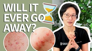 How Long Does It REALLY Take to Get Rid of Acne?