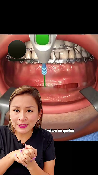 ¿Cirugía de fractura mandibular?💯