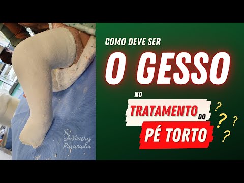 Vídeo: Quando um gesso com agulha deve ser tratado?