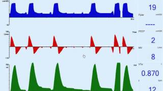 Patient Ventilator Asynchrony: Missed Trigger