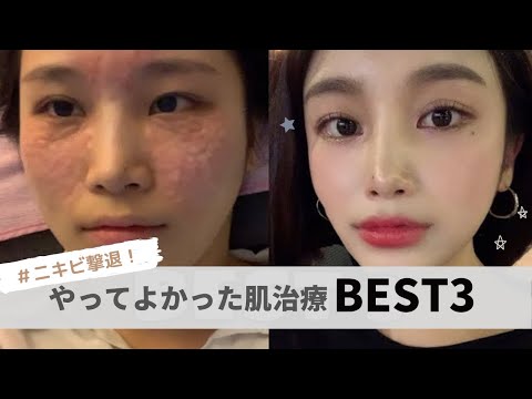 ニキビ　ポツポツ　ゆらぎ肌に良き✨韓国肌管理　CIVASAN pH Derma ニキビ ポツポツ ゆらぎ肌に良き✨韓国肌管理 CIVASAN pH Derma