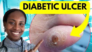 Why Diabetic Foot Ulcers Don’t Heal: Doctor Explains What You’re Missing