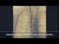 stenting right mapca 3 via carotid artery