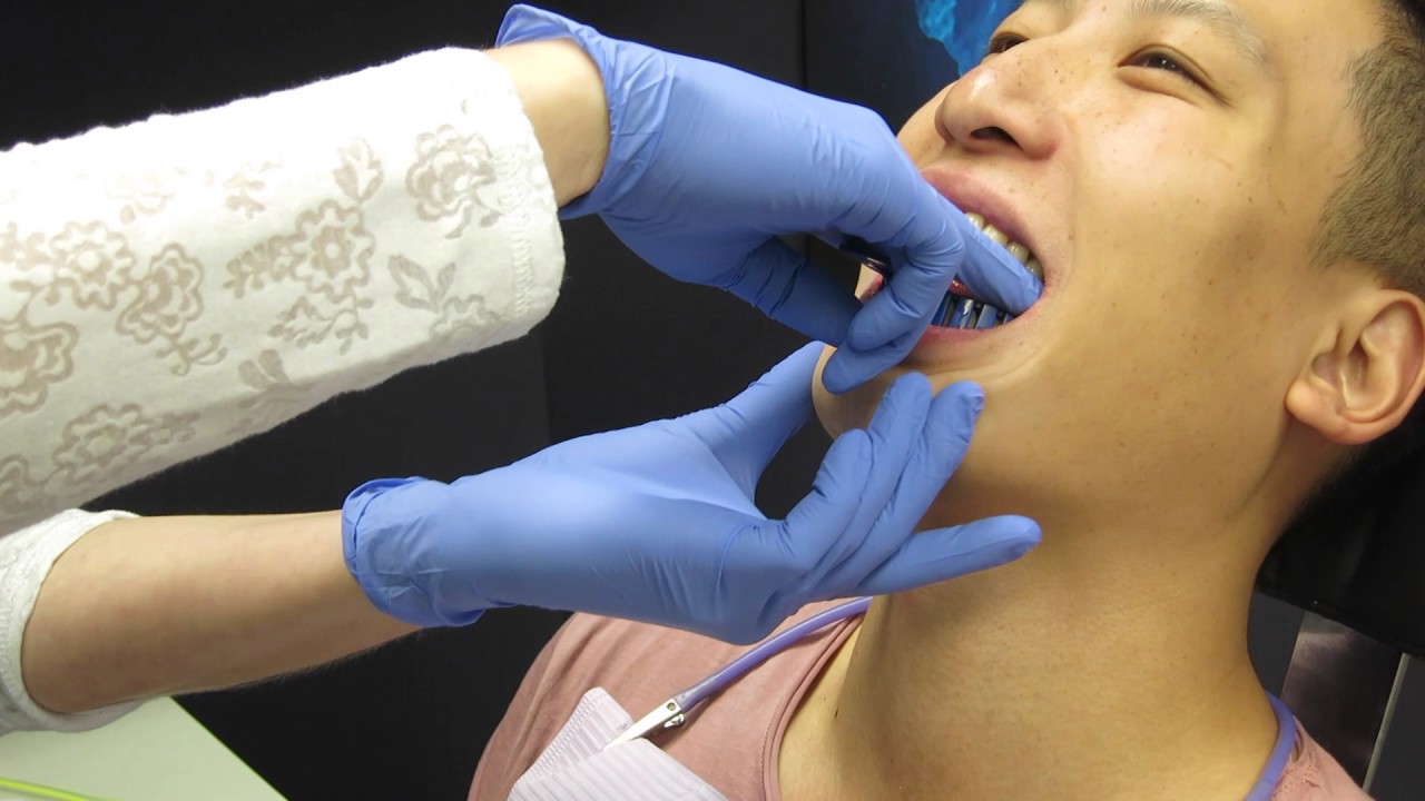 INVISALIGN]] What its like getting a refinement!