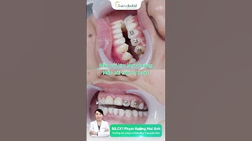 Phân biệt mắc cài kim loại thường và mắc cài tròn tự buộc - Tracydentist