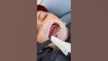 Fast, Accurate, Comfortable | Implant Scan in Minutes. #shortvideo #dentist #dentistry #viral