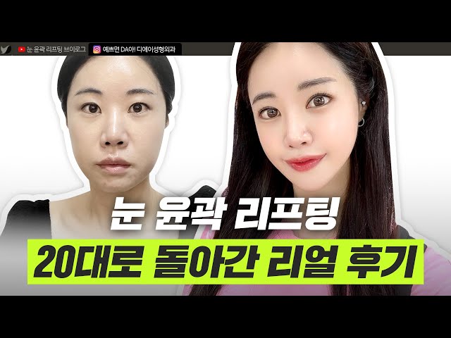 30대 성형 브이로그 ㅣ리프팅, 안면윤곽, 눈성형ㅣ디에이성형외과ㅣ디에이성형외과의원