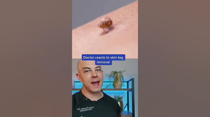 Don’t do this to remove skin tags!!