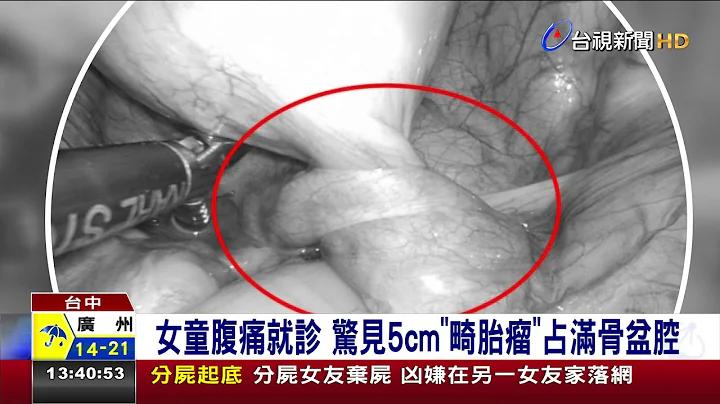 女童腹痛就诊惊见5cm畸胎瘤占满骨盆腔 - 天天要闻