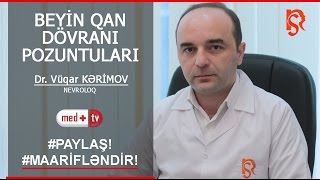 Beyin qan dovrani pozgunlugu - Hekim Nevroloq Vuqar Kerimov İstanbulNS Resimi